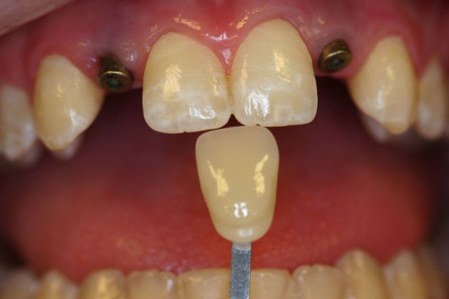 Before Dental Implants